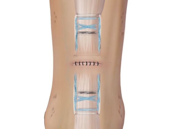 Arthrex - Achilles Tendon Rupture Repair with PARS System